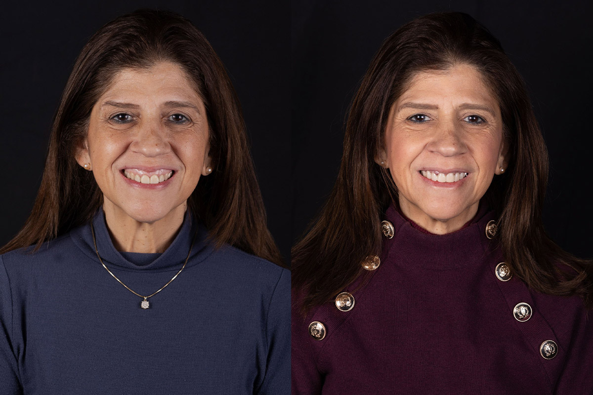 Understanding Implant-Supported Dentures