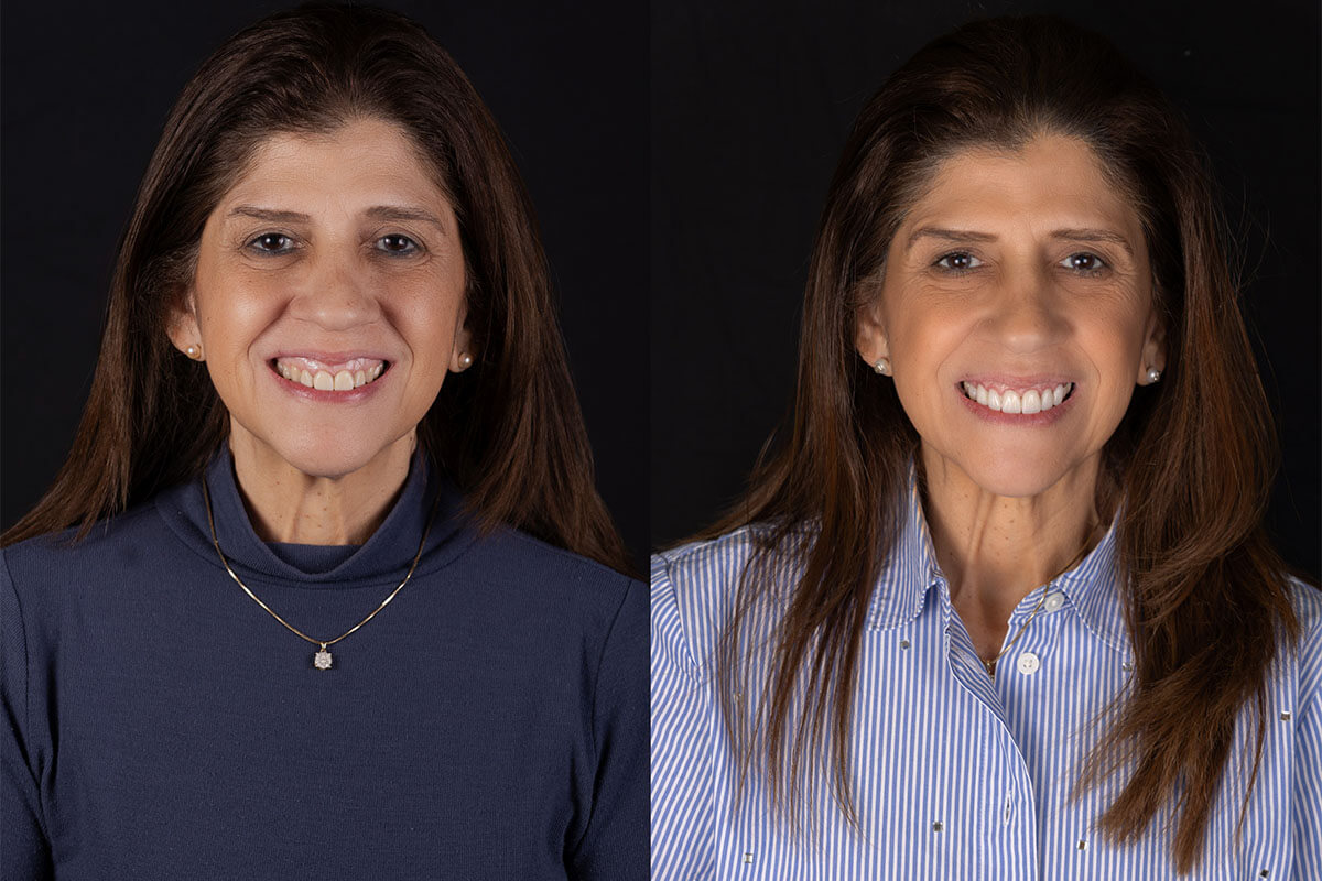 before and after look at dental results provided by Cochituate Smile Center
